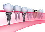 dental-implants